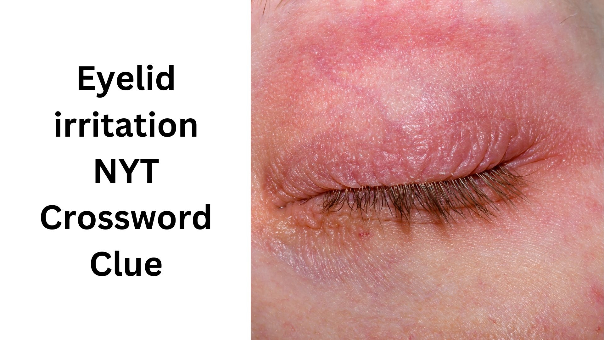 Eyelid Irritation NYT Crossword Clue October 6 2024